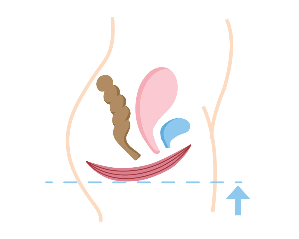 Schematische Darstellung eines gestärkten Beckenbodens nach der Anwendung