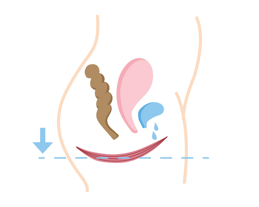 Schematische Darstellung des Beckenbodens vor der Anwendung